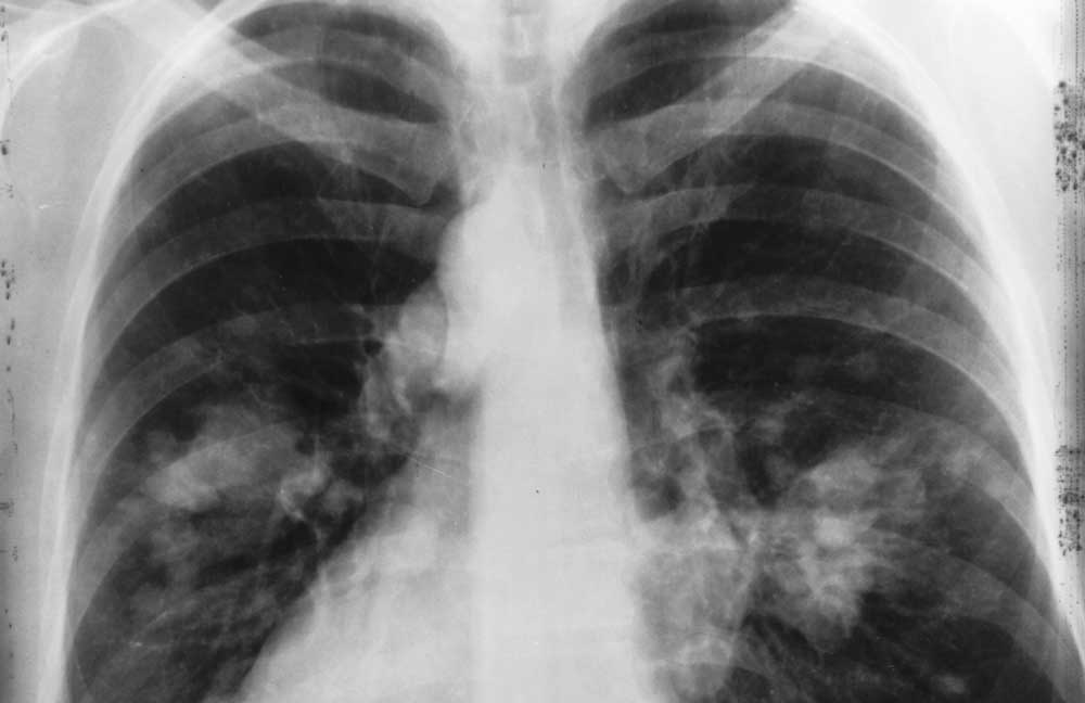A légszennyezés egyik áldozata a tüdőrákos beteg. / Fotó: wikipedia.